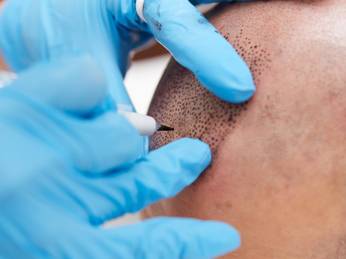 Preparación antes de realizar la tricopigmentación